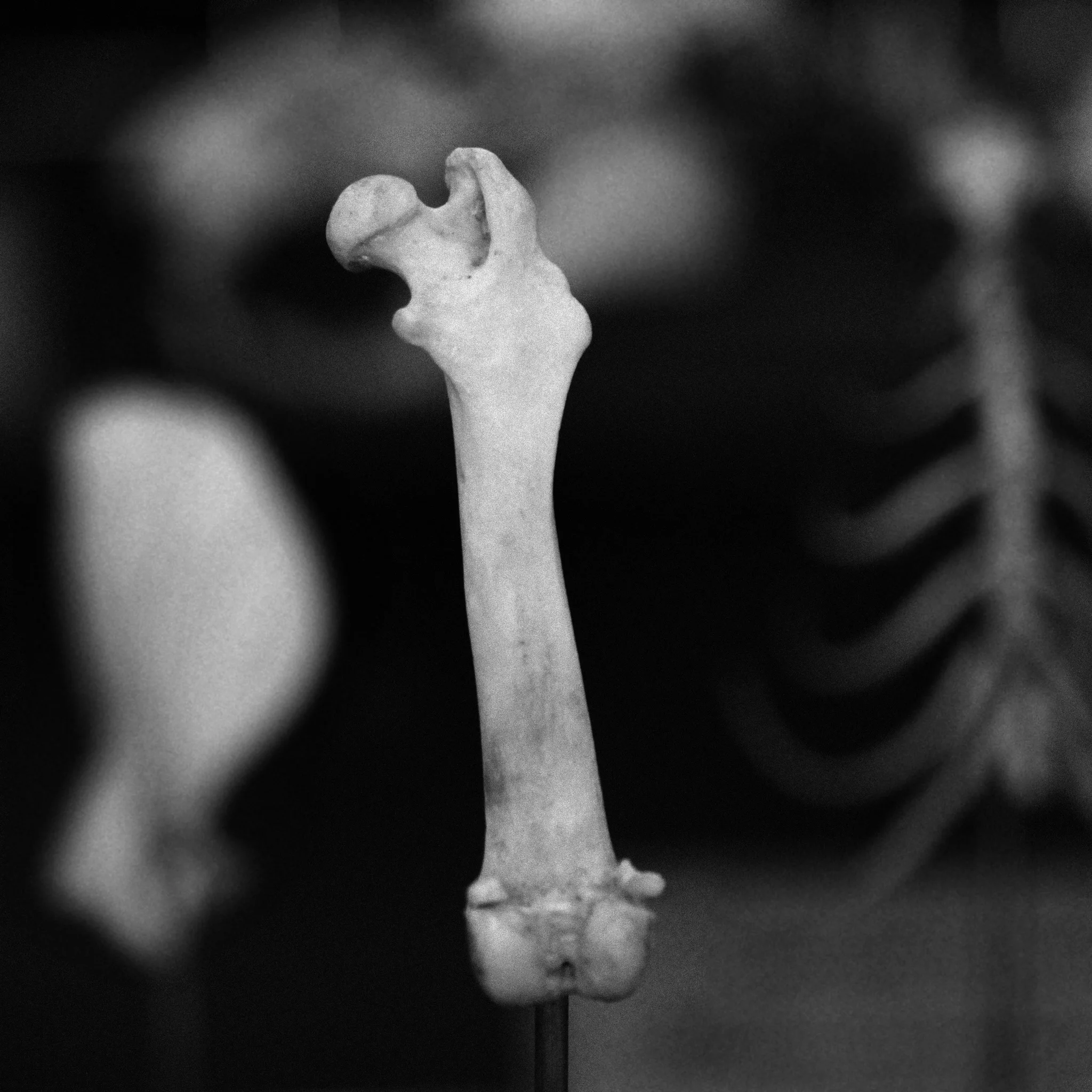 Square fracture IV